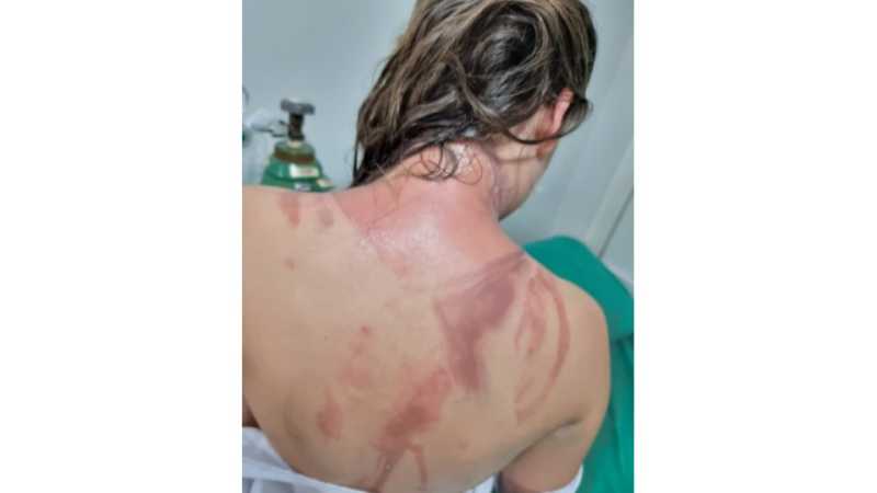 Palotina - Universitários sofrem queimaduras durante aplicação de trote • Portal Guaíra